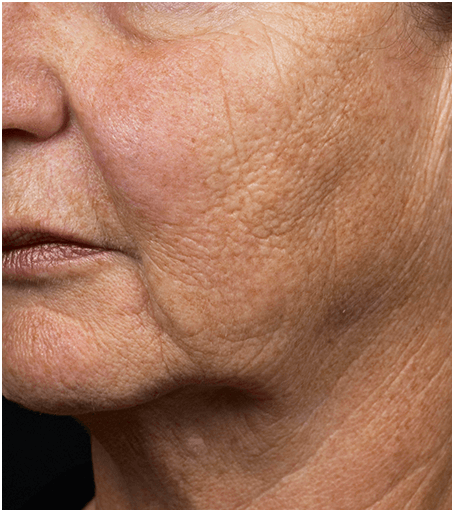 Womans face before treatment with Fraxel fractional skin resurfacing laser