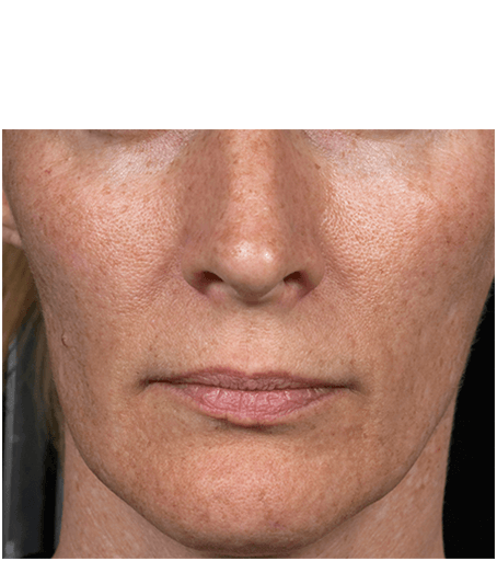 Her face after one treatment with Fraxel fractional skin resurfacing laser