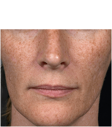 Womans face before treatment with Fraxel fractional skin resurfacing laser