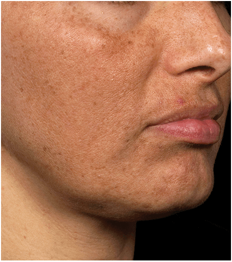 Her face after one treatment with Fraxel fractional skin resurfacing laser