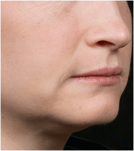 Her face after one treatment with Fraxel fractional skin resurfacing laser