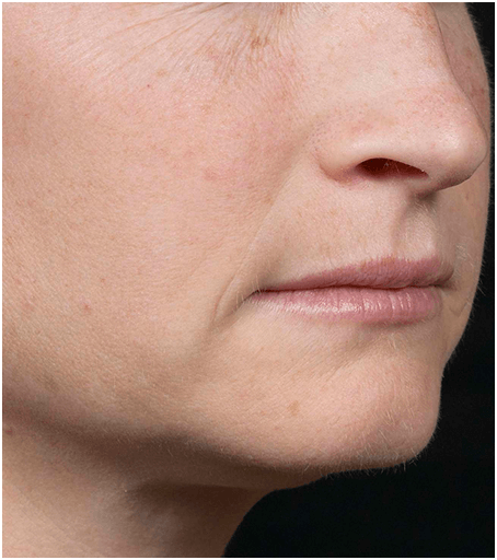 Womans face before treatment with Fraxel fractional skin resurfacing laser