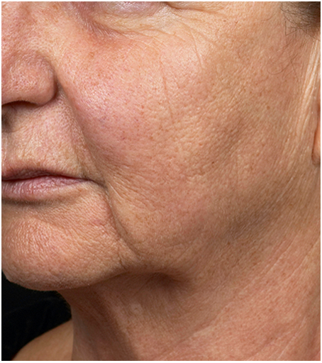 Her face after one treatment with Fraxel fractional skin resurfacing laser