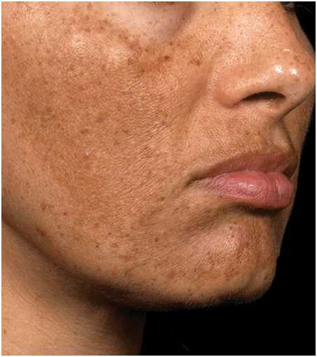 Womans face before treatment with Fraxel fractional skin resurfacing laser