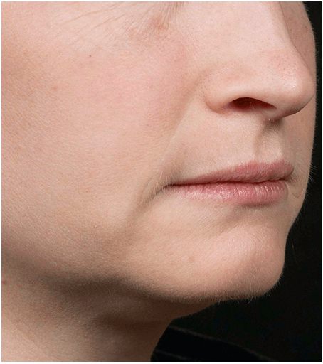Her face after one treatment with Fraxel fractional skin resurfacing laser