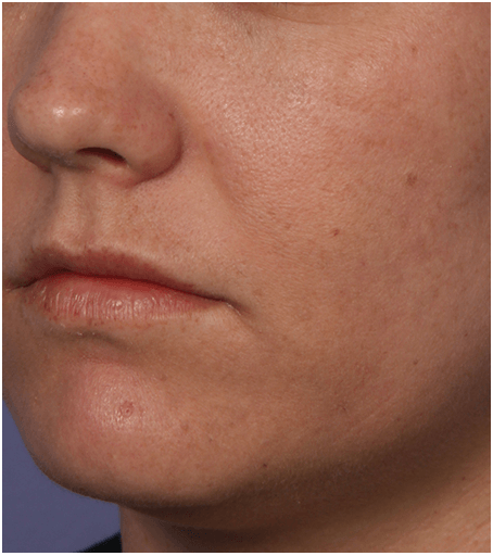 Her face after one treatment with Fraxel fractional skin resurfacing laser